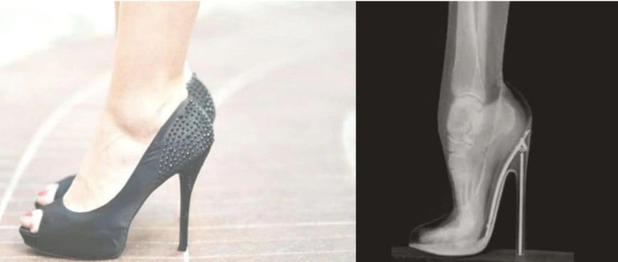 The Cost of Wearing High Heels